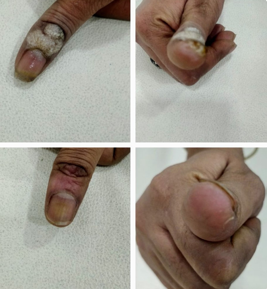wart-removal treatment